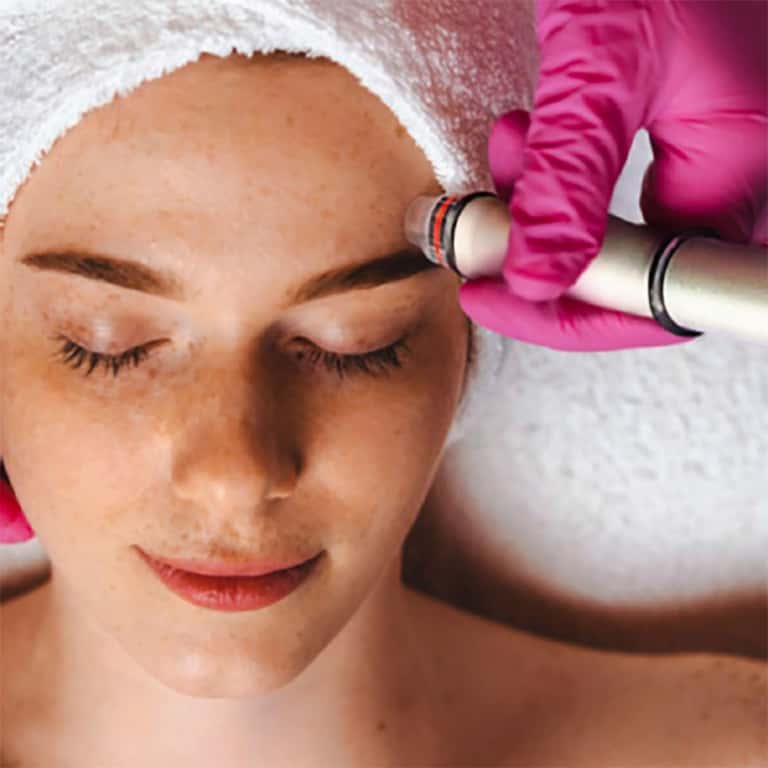 75-Minute Stem Cell-Infused Microneedling