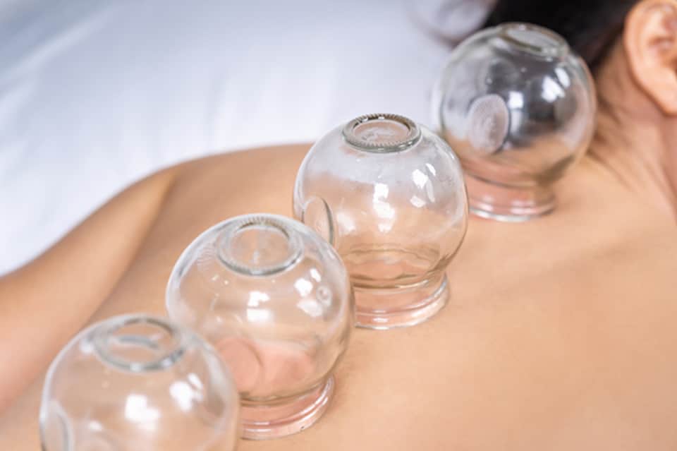 Close-up of glass cupping therapy cups placed on client's back during spa treatment