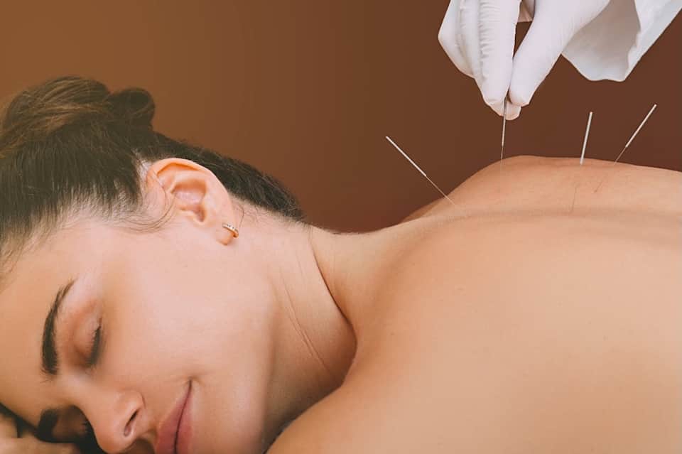 Acupuncture treatment on patient's back with fine needles